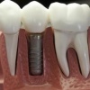 Чем имплантация зубов лучше протезирования?