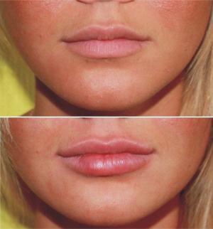 Операция по увеличению губ, до и после